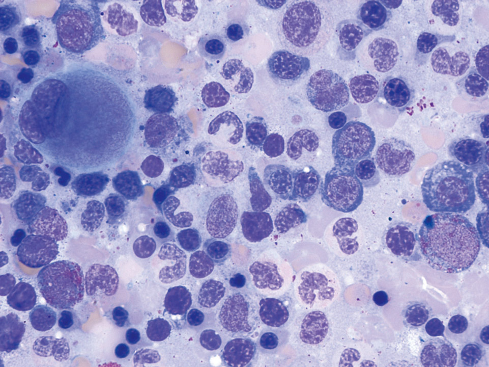 Bone marrow cytology showing dysplastic changes in all cell lineages